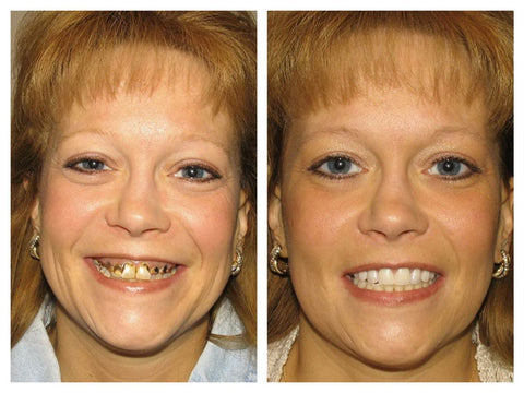 Bain de bouche New Teeth